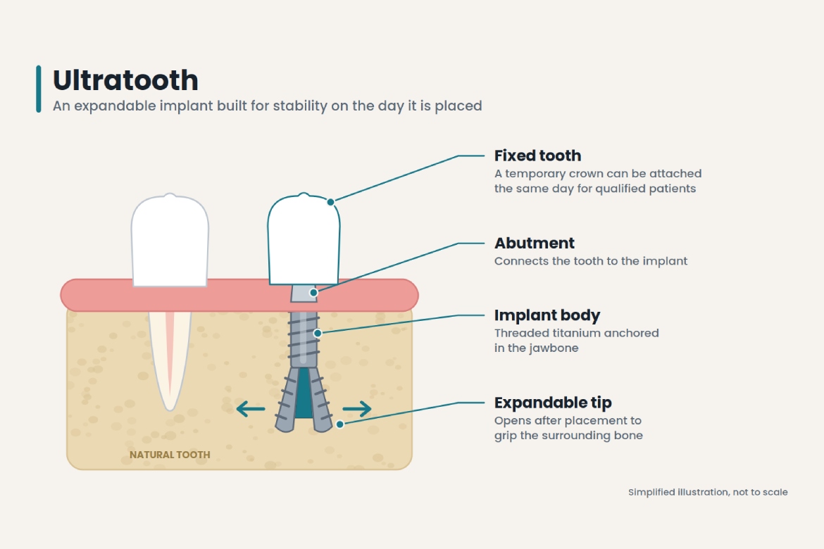 ultratooth dental implant