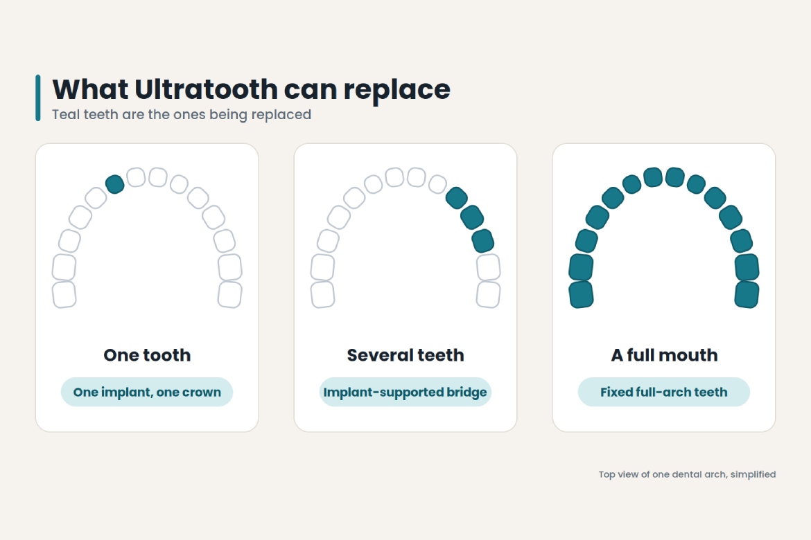 ultratooth dental implant vs all on 4