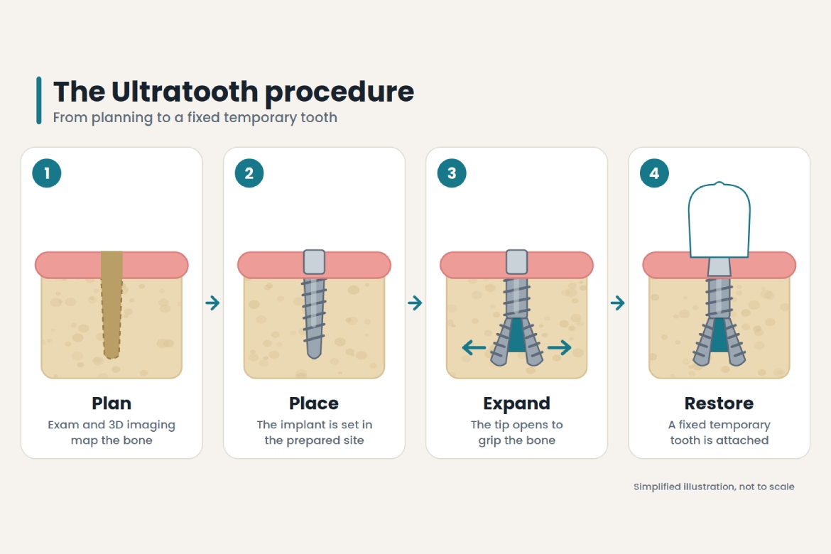 ultratooth dental implant procedure
